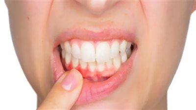 ارتفاع مستويات السكر في الدم يؤدي إلى نزيف اللثة