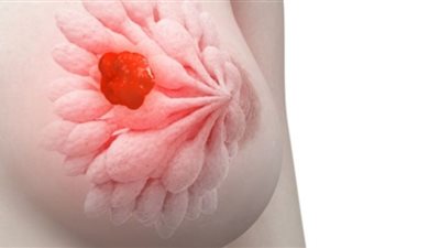 خطة الصحة لعلاج سرطان الثدي.. كشف وعلاج مجانًا