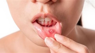 بكتيريا خطيرة في الفم تسبب أمراض قاتلة.. أطباء يحذرون