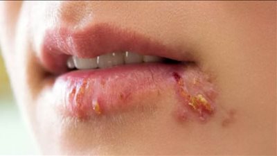 فيروس الهربس قد يتغلب على السرطان.. علماء يوضحون