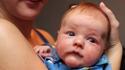 الحساسية وإصابة الأطفال بالحُمى.. طبيبة تحذر من كارثة