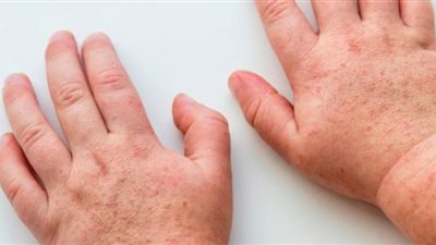 الحمى العقدية القرمزية.. بريطانيا تواجه زيادة الإصابات
