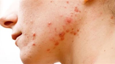 التمارين الرياضية تُقلل ظهور حب الشباب لدى المراهقين