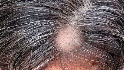 3 حالات تسبب ظهور علامات الشيب المبكرة وأورام الدماغ عارض منها