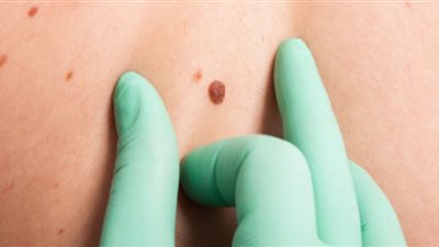 كيف تحمي نفسك من الإصابة بسرطان الجلد