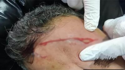 التعدي على طبيب بمستشفى كفر الزيات وإصابته بـ 15 غرزة