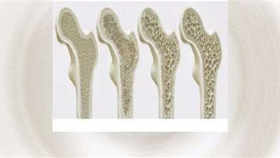 ارتفاع هشاشة العظام لدى النساء عند سن اليأس.. تلوث الهواء في مرمى الاتهام