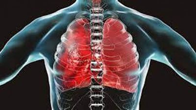 نجاح زرع رئة مزدوجة.. انقاذ حياة شخصين مصابين بالسرطان