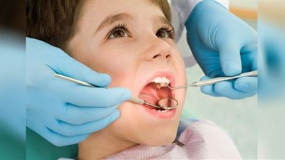 دعوة لوقف استخدام حشوات «أملغم» الزئبقية في علاج أسنان الأطفال