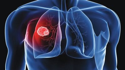 الصحة تكشف أهمية مبادرة صحة الرئة (شاهد)