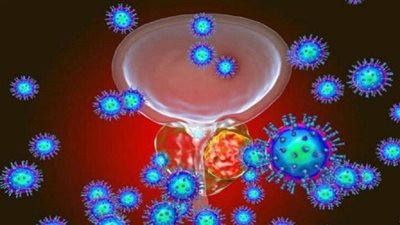 طبيب يكشف أخطر عمر للإصابة بسرطان البروستاتا