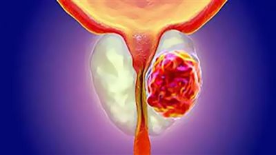 مشاكل التبول الشائعة تشير إلى تضخم البروستاتا