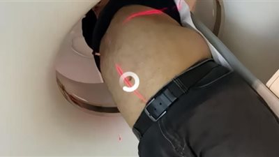 حمل رجل أربعيني حالة نادرة تسجل للمرة الأولى (فيديو)