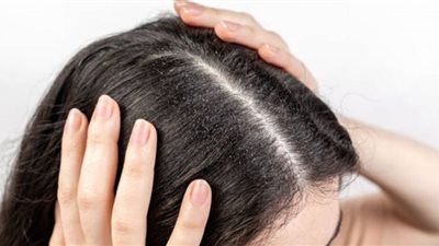 تخلصي من القشرة بـ جوزة الطيب