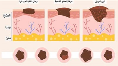 لسة في أمل | لقاح جديد يمنع انتشار سرطان الجلد