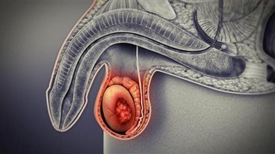 عوامل الخطر التي تشير للإصابة بسرطان الخصية.. اكتشفها
