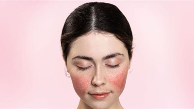 احذر.. أصحاب هذا المرض الجلدي ممنوعين من شُرب القهوة