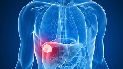 5 طرق للوقاية من سرطان الكبد