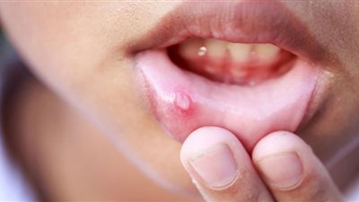 أنواع سرطان الفم من الخفيفة إلى الخطيرة