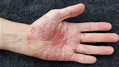 الصدفية مرض مناعي مزمن.. تعرف على علامات تظهر قبل الإصابة بها