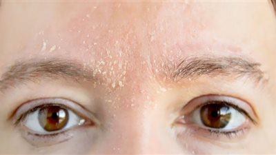 6 حالات تسبب جفاف البشرة