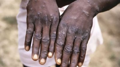 جدري القرود ينتشر مجددًا.. فترة الحضانة والأعراض