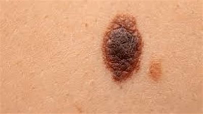 الورم الميلانيني.. طفرة بروتين تؤدي لتطور السرطان