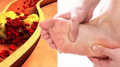 الكوليسترول خطر يهدد البشرية.. علامة في أصابع القدمين