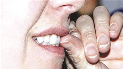 قضم الأضافر والصدفية أمراض جلدية بسبب التوتر والقلق 