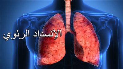 الانسداد الرئوي.. الإغماء وضيق التنفس أبرز أعراض الإصابة