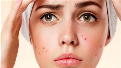 5 أطعمة تزيد من حب الشباب في الصيف