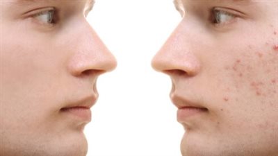 انسداد بصيلات الشعر.. أسباب ظهور حب الشباب