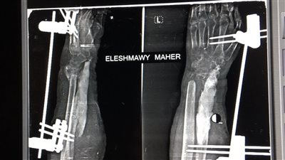 جراحات عظام متقدمة في الزقازيق العام بالشرقية