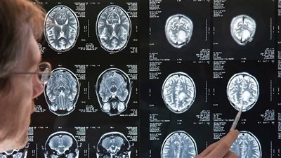 طرق الوقاية من أورام الدماغ.. الابتعاد عن التدخين الحل الأمثل