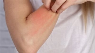 أكثر أنواع الحساسية شيوعًا بين الناس.. الفول السوداني أبرزها