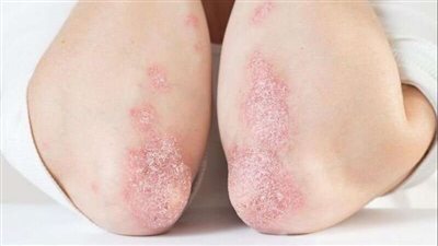 علاقة مرض التهاب الأمعاء بالصدفية والتهاب المفاصل الصدفي