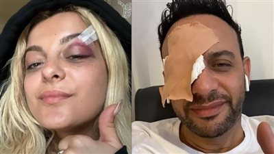 لعنة إصابات العين تُطارد المشاهير وبيبي ريكسا وأفا ماكس صُدفة مستحيلة (شاهد)