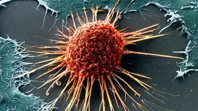 أعراض تحذرك من الإصابة بمرض السرطان