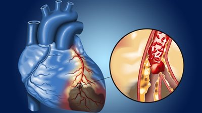 الثوم وزيت الزيتون الحل المثالي لانسداد الشرايين