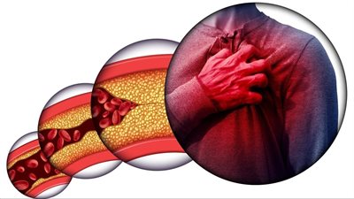 أطعمة أثبتت فعاليتها في خفض مستوى الكوليسترول 