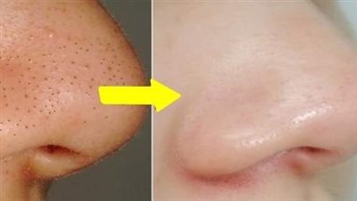 4 ماسكات تخلصك من الرؤوس السوداء في العيد