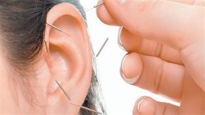 7 فوائد للإبر الصينية فى التخسيس وعلاج الأمراض