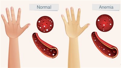 أسباب فقر الدم الناجم عن نقص الحديد.. الحمل أبرزها