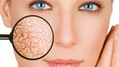 علماء يطورون طريقة تعالج الحروق دون ترك ندبات