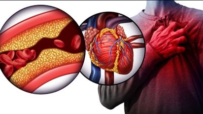 الفرق بين أعراض احتشاء عضلة القلب والجلطة الدماغية