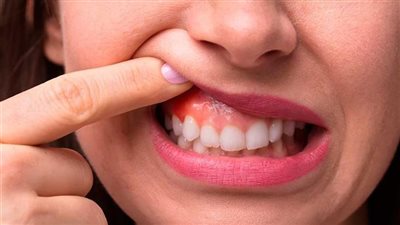 التهاب اللثة طريق للإصابة بمرض الزهايمر.. دراسة تكشف مفاجأة 