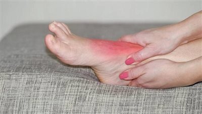 يسبب التهاب المفاصل.. أسباب الإصابة بداء النقرس