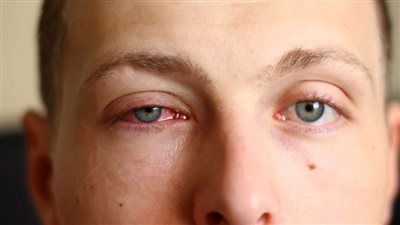 تسمي بالعين الوردية.. ما هو التهاب الملتحمة وأشهر أنواعه