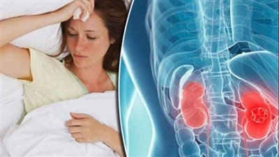 هل التهاب الكبد يسبب مرض مزمن خطير في الكلى؟.. أطباء يحسمون الجدل