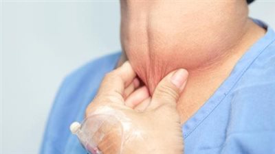 6 أطعمة تحتوي على اليود لمرضى الغدة الدرقية.. الجبن أبرزها 